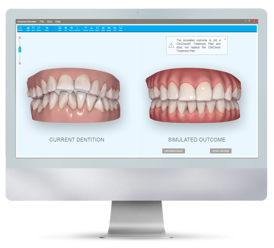 2 18 itero-口腔数字化扫描高科技神器 itero·sunny dental 更舒适